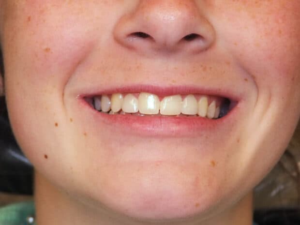 The same patient's smile after whitening treatment