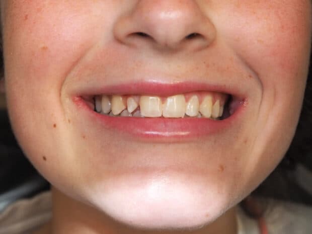 A patient's smile before whitening treatment